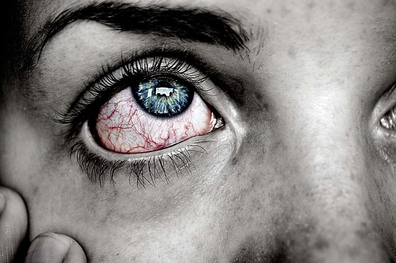 Eye Infection (Pixabay Free Image) - AspirantSG
