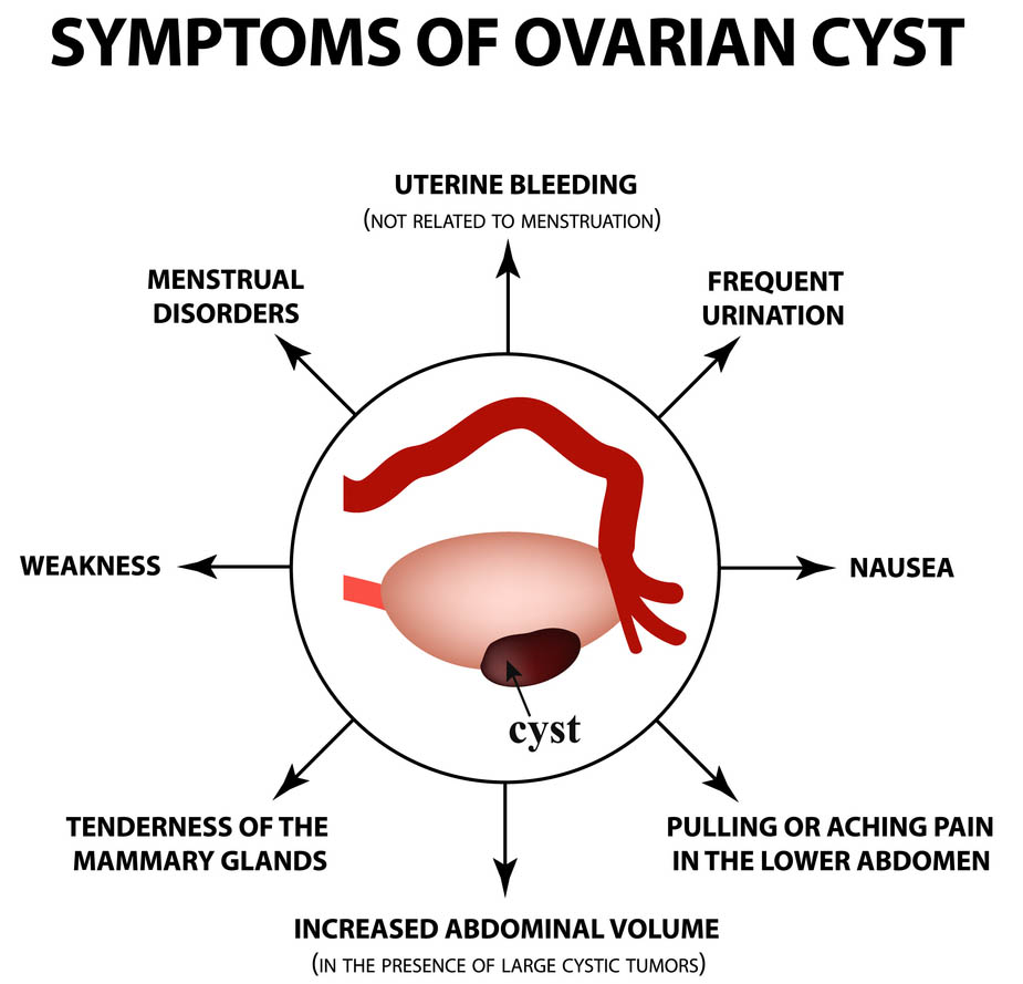 Ovarian Cysts What Are They And What Are The Treatment Options