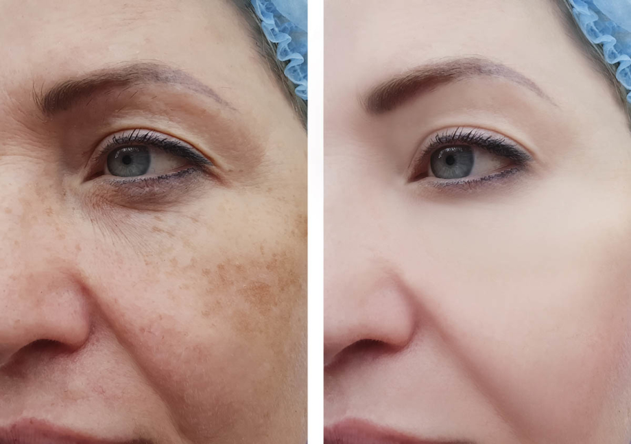 Cost Of Pigmentation Treatments In Singapore