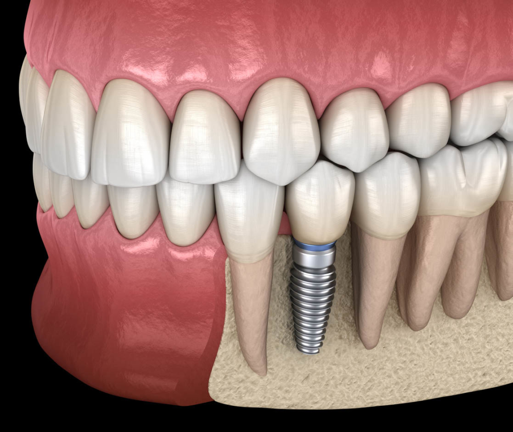 Dental Implants 101 A Guide To Dental Implant Surgery in Singapore
